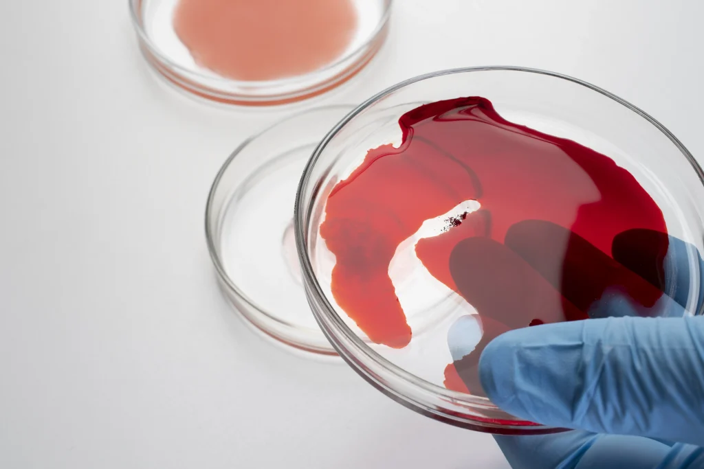 Haemophilia B