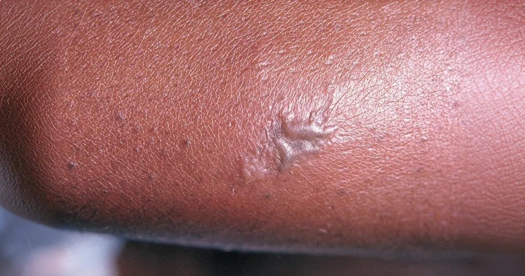 Gonorrhoea
