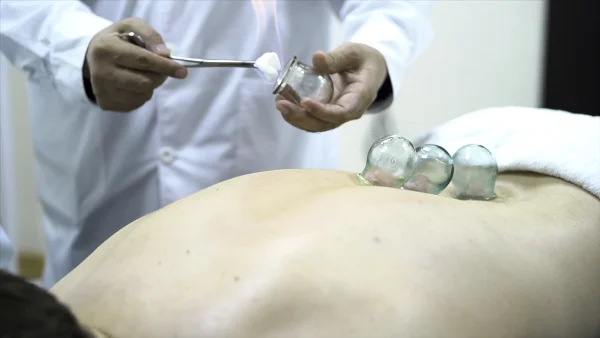 Cupping Therapy